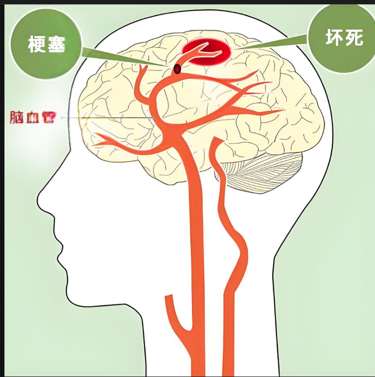 临沂治脑梗哪家医院好