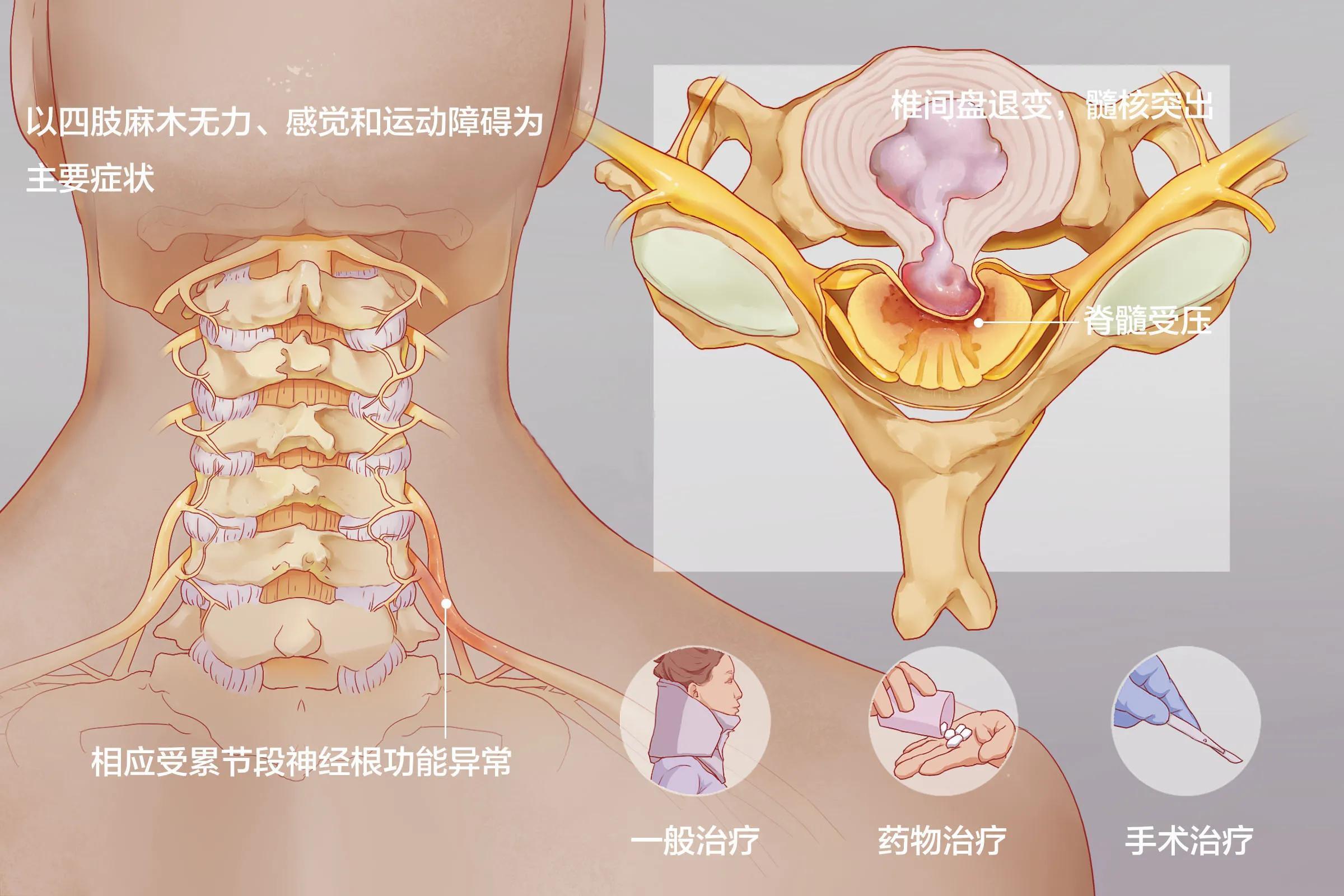 临沂治疗颈椎病的医院
